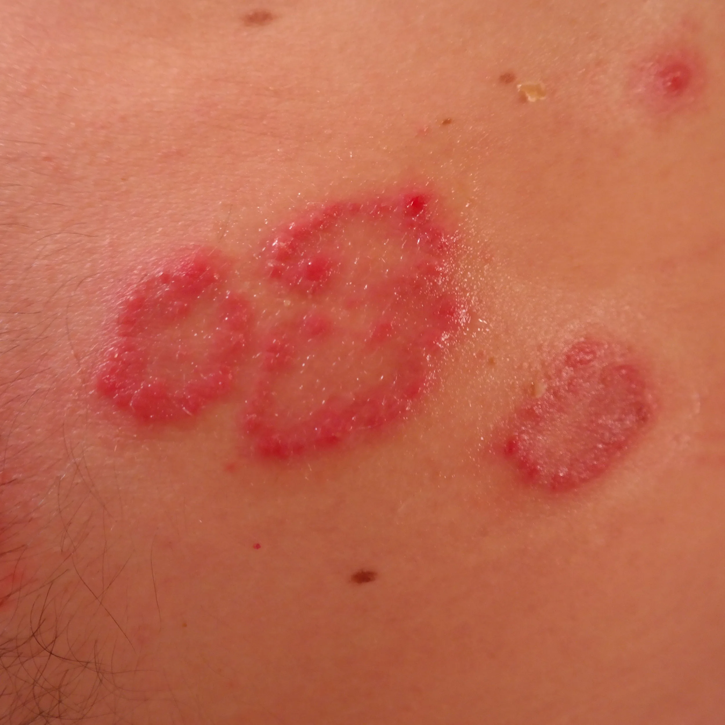 Read more about the article PSORIAAS – loodusravi psoriaasi (erinevate nahahaiguste) korral