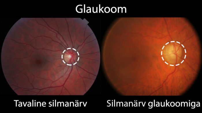 Glaukoom