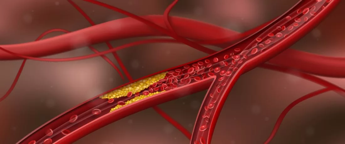 Kolesterool_veresooned_kõrge_kolesterooli_sümptomid