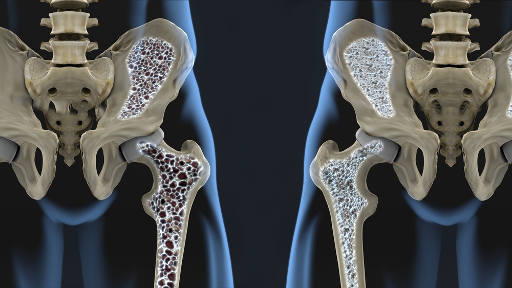 Osteoporoos ehk luuhõrenemine