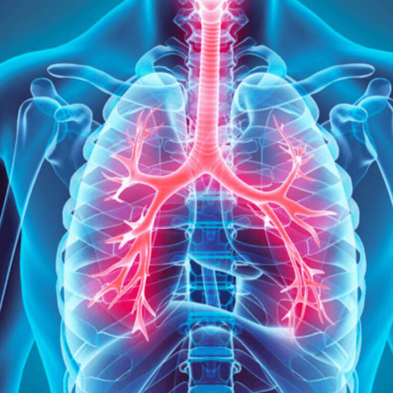 BRONHIIT – millega end toetada bronhiidist paranemisel?