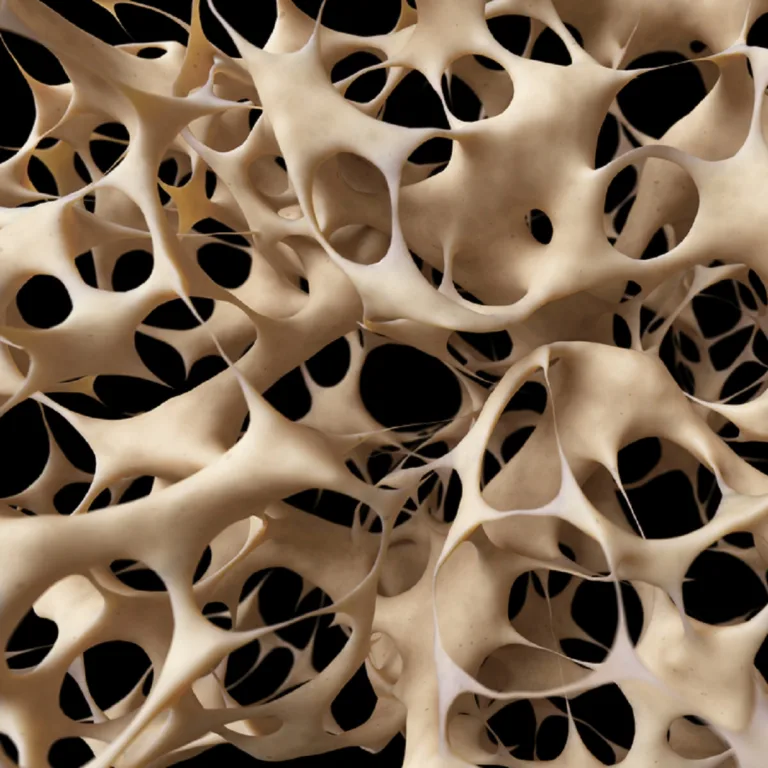 Read more about the article OSTEOPOROOS – sümptomid, põhjused, riskigrupid, ennetus ja ravi